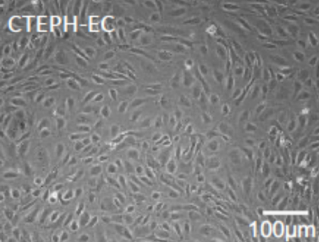 Comparación del perfil metabólico de las células endoteliales de pacientes con HPTEC y HAP