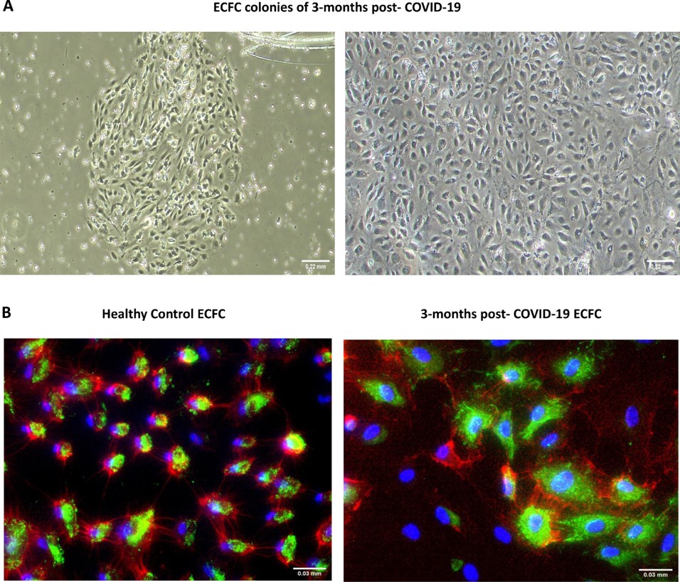 Los pacientes que han superado la COVID-19 presentan un incremento en la producción de células endoteliales progenitoras